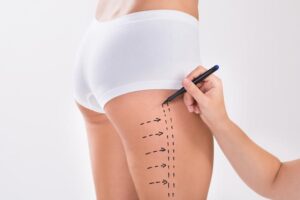 Surgery Method Explained by Best Liposuction Surgeons in Dubai