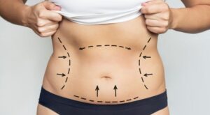How Safe Is Vaser Liposuction in Dubai Today?