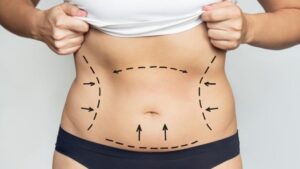 How Safe Is Vaser Liposuction in Dubai Today?