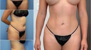 Finding the Best Doctors in Dubai for Safe Body Contouring