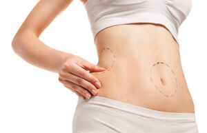 How Liposuction Can Boost Your Self-Esteem