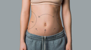 Liposuction Procedure: What Makes It Different?