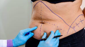 Bariatric Surgery Cost Structure Offering Clear Wellness Insight