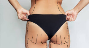 Liposuction Strategies to Support Confident Body Transformation
