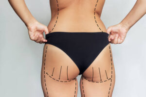 Liposuction Strategies to Support Confident Body Transformation