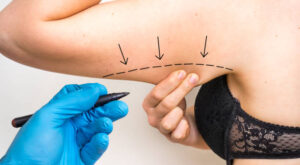 How to Plan for Liposuction in Riyadh: Consultation to Recovery