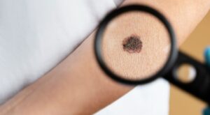 Myths & Facts About Mole Removal in Dubai: Clearing Confusion