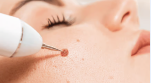 Mole Removal in Dubai: When It’s Cosmetic vs. Medical Necessity