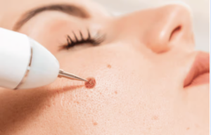 Mole Removal in Dubai: When It’s Cosmetic vs. Medical Necessity