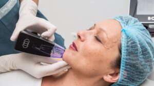 Morpheus8 for Cheek Lifting: How It Works