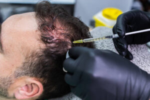 PRP Hair Treatment vs. Other Hair Restoration Methods Compared