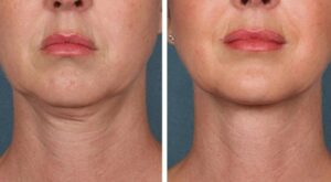 Best Aesthetic Clinics in Dubai for PRP Injections: Smooth & Healthy Skin