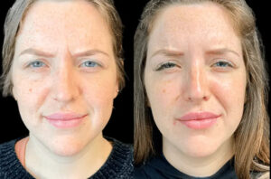 Why the Best Doctors in Dubai for Botox Are in High Demand in 2025