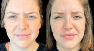 Natural-Looking Botox Results: Tips from the Best Plastic Surgeon in Dubai