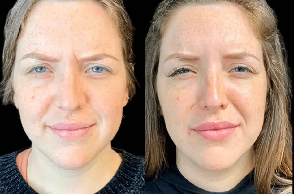 Natural-Looking Botox Results: Tips from the Best Plastic Surgeon in Dubai