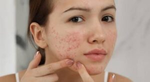 Pimples Treatment in Dubai: Innovative Options Available