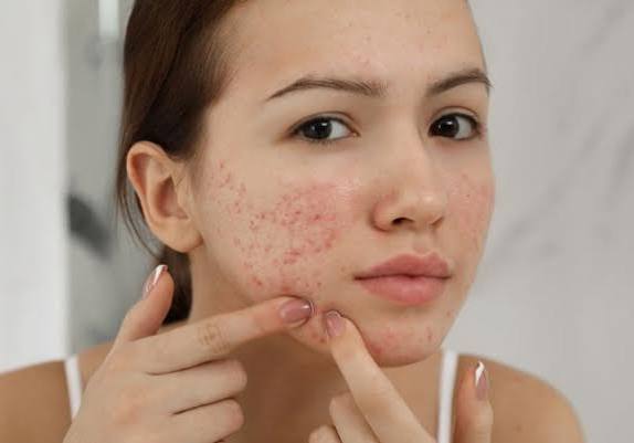Pimples Treatment in Dubai: Innovative Options Available