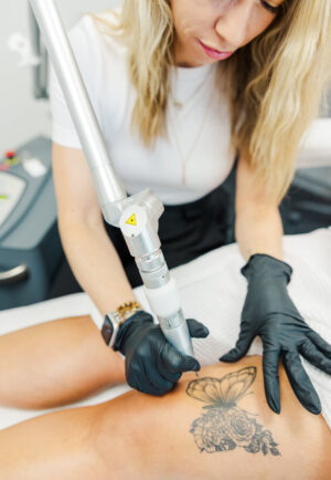 Quick Tattoo Fading with Laser Treatments