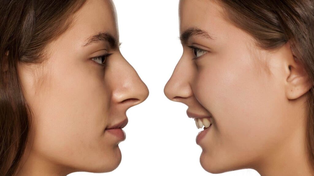 Rhinoplasty in Dubai