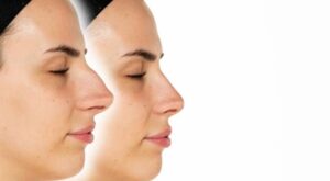 Digital Nose Mapping: The Future of Rhinoplasty in Dubai