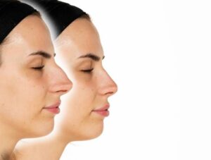 Digital Nose Mapping: The Future of Rhinoplasty in Dubai