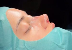 Advanced Rhinoplasty in Dubai: Where Science Meets Beauty