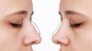 Combining Rhinoplasty in Dubai with Chin Augmentation for Better Balance