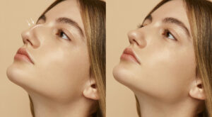 How Long Do Results Last from Rhinoplasty in Dubai?