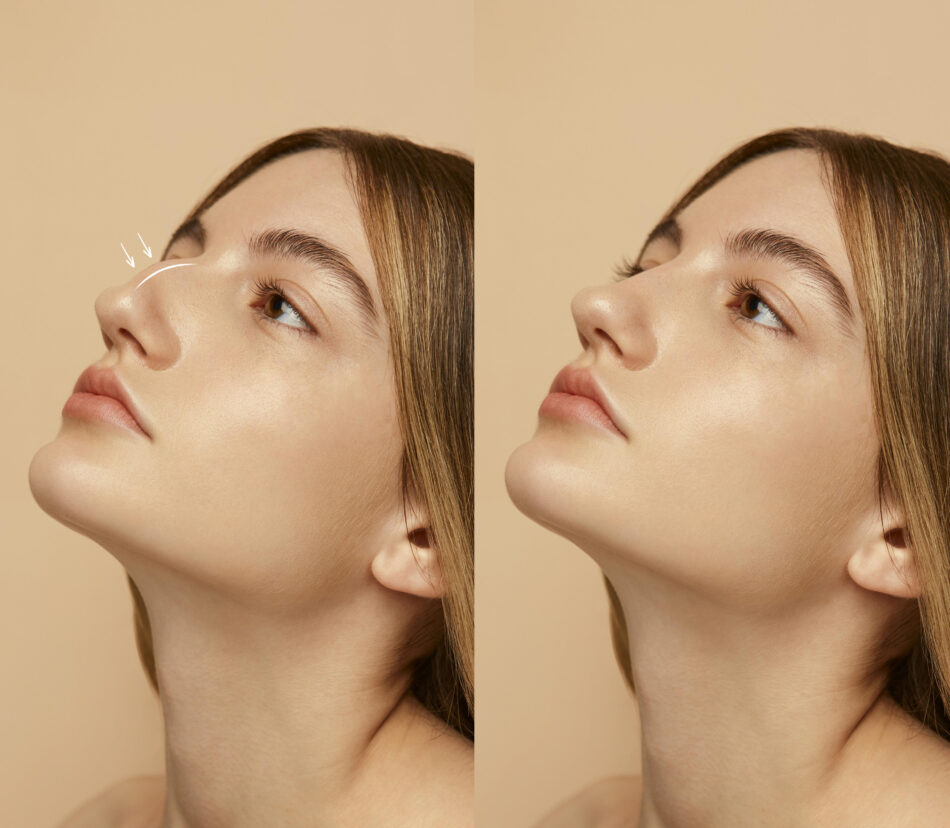 How Long Do Results Last from Rhinoplasty in Dubai?
