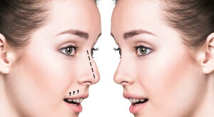 Rhinoplasty in Dubai