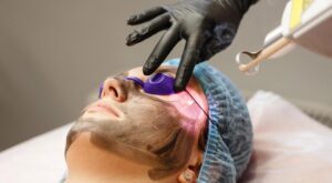 Safe and Effective Laser Carbon Peel Options