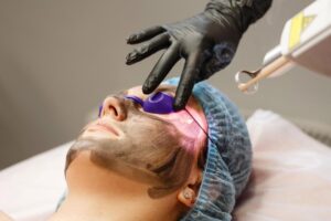 Safe and Effective Laser Carbon Peel Options