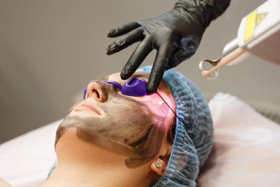 Safe and Effective Laser Carbon Peel Options