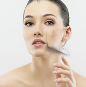 Scar Removal in Dubai: Expert Advice on Treating Acne Scars
