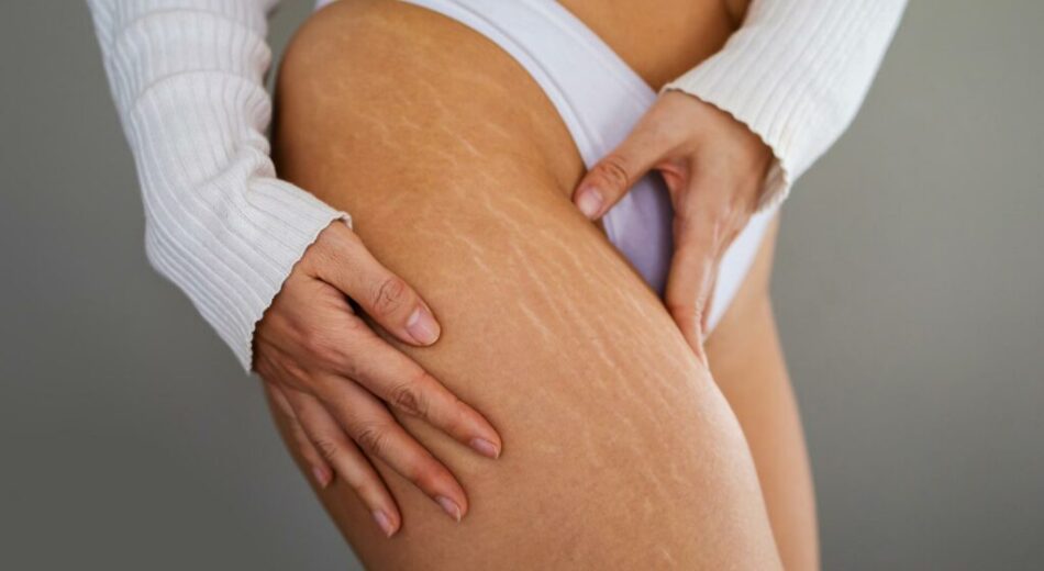 Why Stretch Marks Appear and How Laser Stretch Marks Treatment Helps