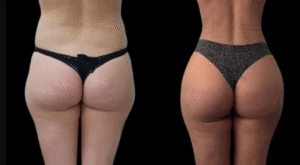 Comparing J-Plasma in Dubai with Other Skin Tightening Treatments