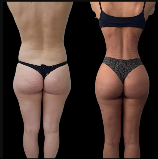 Comparing J-Plasma in Dubai with Other Skin Tightening Treatments