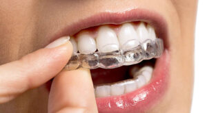 Clear Aligner Innovation in Simpsonville for a Confident, Natural Smile