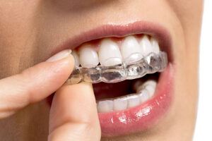 Clear Aligner Innovation in Simpsonville for a Confident, Natural Smile
