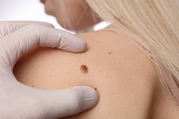 What Precautions Should You Take After Skin Tag Removal?