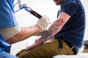 Tattoo Removal in Dubai: Prices Starting at 499 AED
