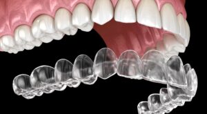 How Teeth Aligners Work Step By Step For Perfect Results?