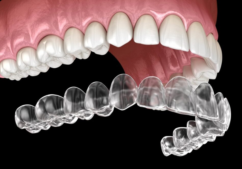 teeth aligners perth