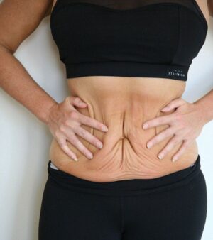 Tummy Tuck in Dubai: How to Achieve a Flatter Stomach Safely