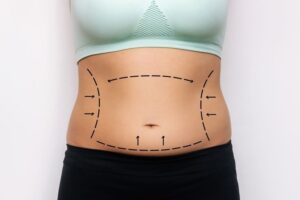 Tummy Tuck in Dubai: Ideal Candidates Explained by Experts