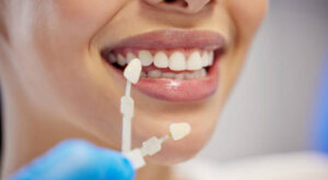 What Makes Dental Veneers a Top Cosmetic Choice?