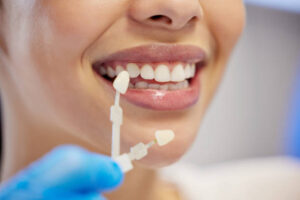 What Makes Dental Veneers a Top Cosmetic Choice?