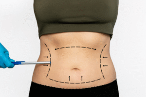 What are the most common myths about liposuction in Dubai?