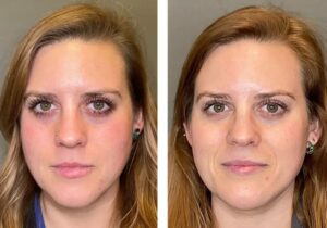 What are the risks or side effects of getting a HydraFacial in Dubai?