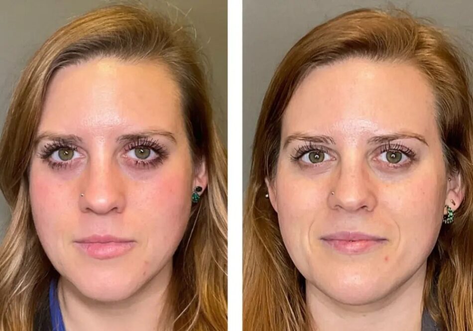 What are the risks or side effects of getting a HydraFacial in Dubai?